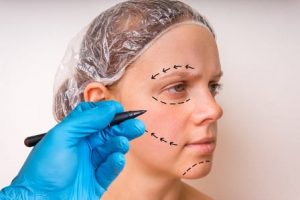 Woman preparing for brow lift