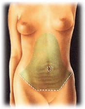 tummy 2 - ABDOMINOPLASTY - TUMMY TUCK