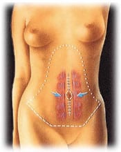 tummy 3 - ABDOMINOPLASTY - TUMMY TUCK