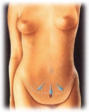 tummy 4 - ABDOMINOPLASTY - TUMMY TUCK