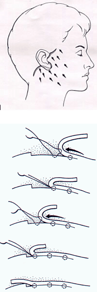 Animated diagram demonstrating a facelift