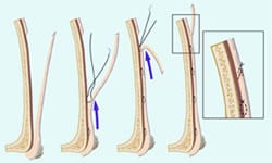 Brow Lift Diagram