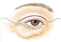 Eyelid Surgery Diagram