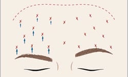 Brow Lift Procedure Rendition 