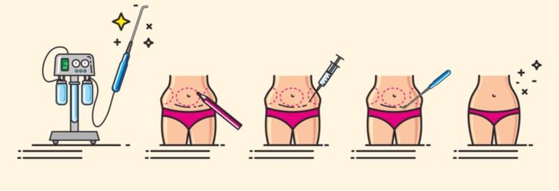 Illustration showing how liposuction is performed.