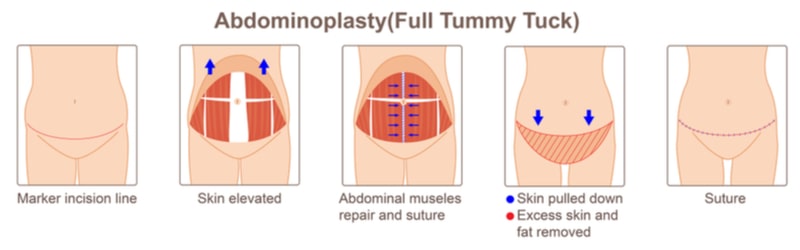 Illustration showing how a tummy tuck is performed.